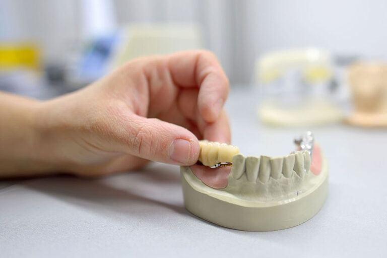 Hand von Zahntechniker mit Gebissmodell