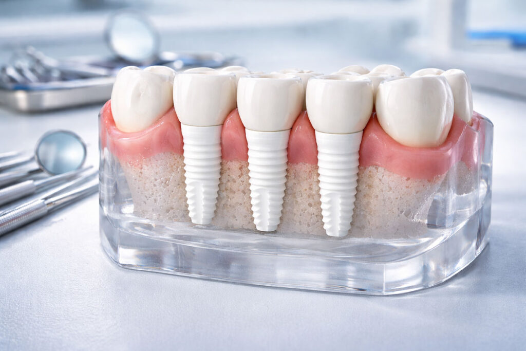 Keramikimplantate CERALOG PROGRESSIVE LINE als Modell