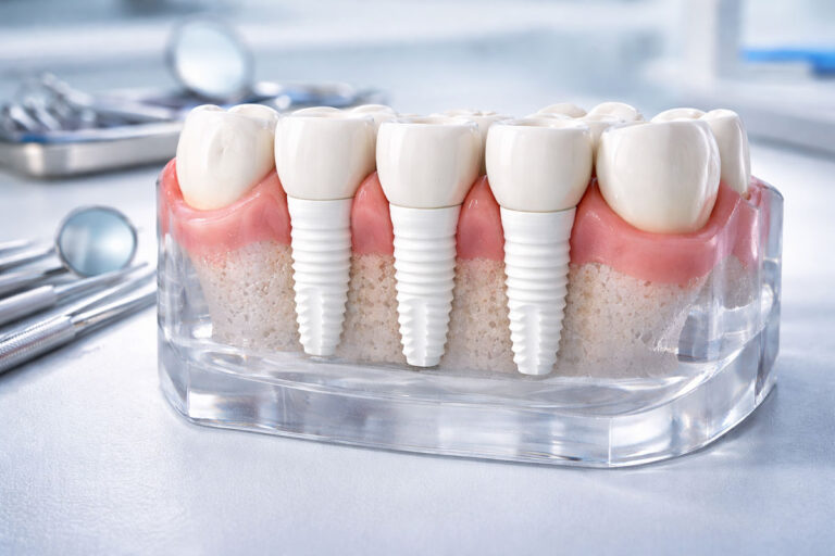 Keramikimplantate CERALOG PROGRESSIVE LINE als Modell